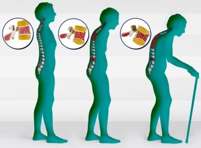 Osteoporose